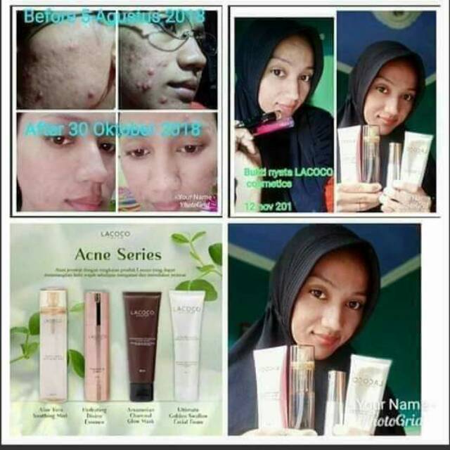 paket lacoco nasa untuk wajah berjerawat