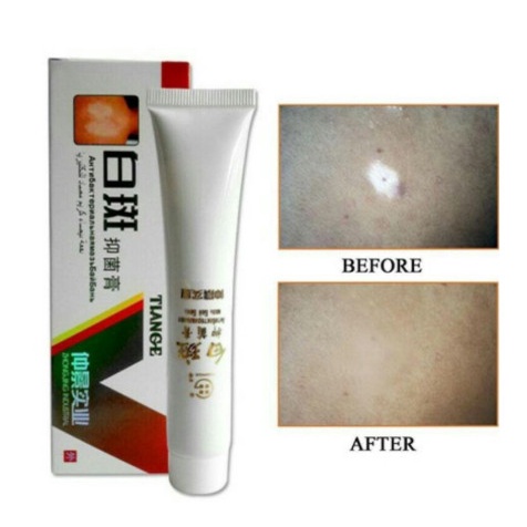 Obat SALEP VITILIGO BERCAK PUTIH / BINTIK PUTIH / Leukoplakia Pigmentasi / Krim Vitiligo Herbal Tiange Cream