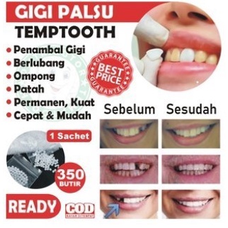 ✨ BISA COD ✨ Snap On Smile Gigi Palsu Instan Veneer Atas Bawah Original 100% - PENAMBAL GIGI