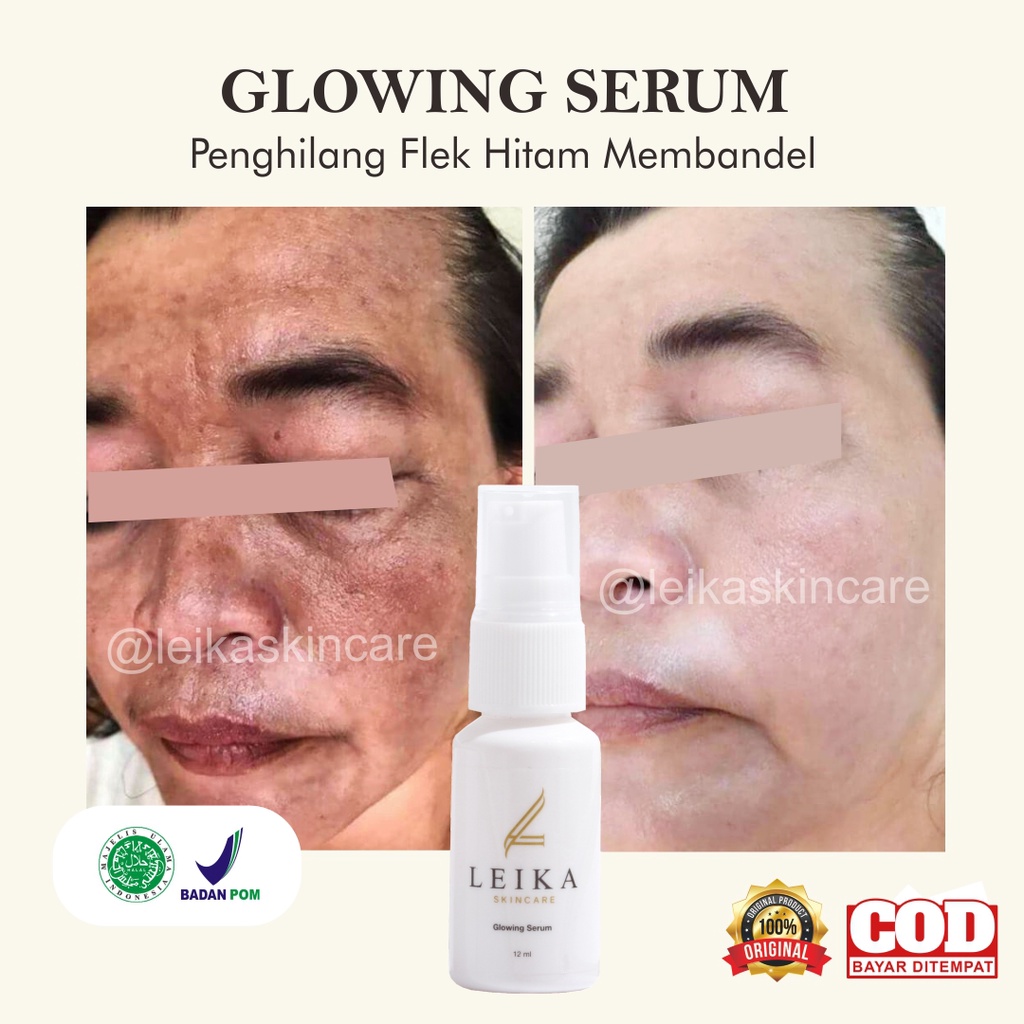 Serum Penghilang Flek Hitam Ampuh Perawatan Penghilang Bintik Hitam Di Wajah Serum Flek Hitam 100% B