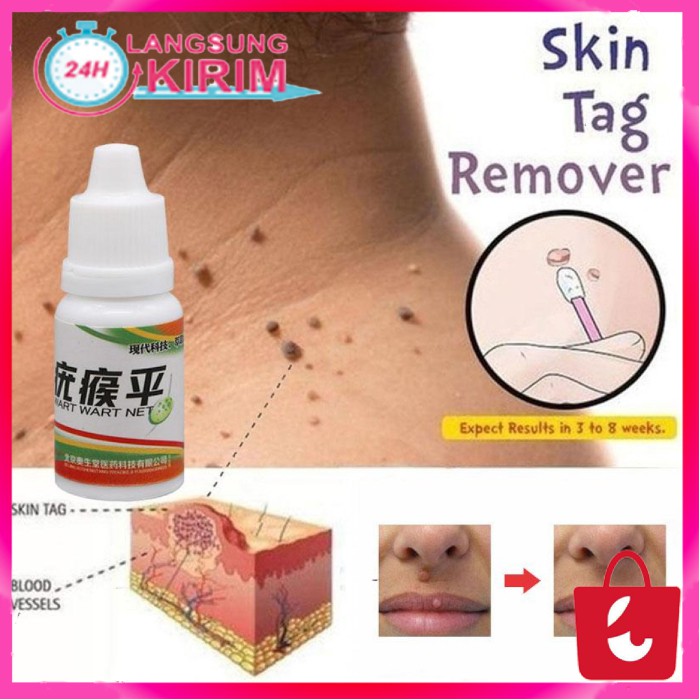 [100% Efektif] Obat Penghilang Tahi Lalat Obat Kutil Obat Kutil Kelamin Skin Taq Remover 10 ml