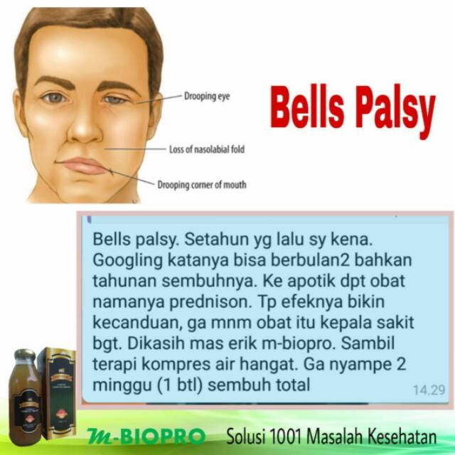 Bells palsy adalah