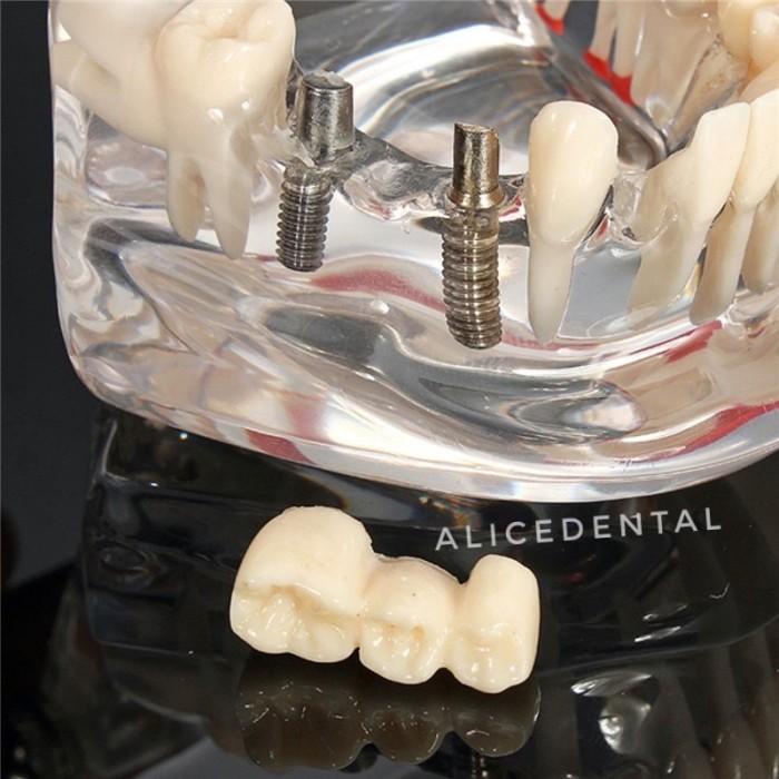 Model studi gigi implant crown bridge bening transparan phantom dental