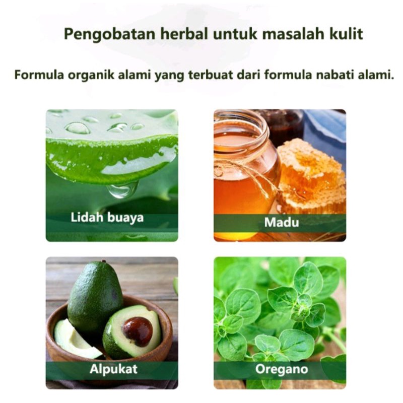 Herbal tinea corproris cream/salep gatal jamur-kudis-kurap-panu dll