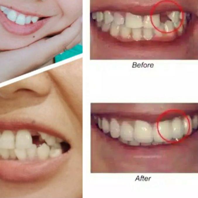 PROMO PENAMBAL GIGI OMPONG TEMPTOOTH ORIGINAL MURAH 300 BUTiR Lebih