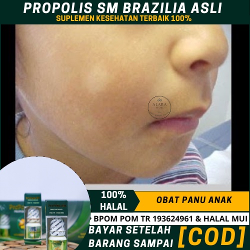 Obat Oles Panu Anak, Panu Di Wajah Anak, Di Pipi, Tangan Dan Kaki, Penghilang Panu   Anak, Obat Panu