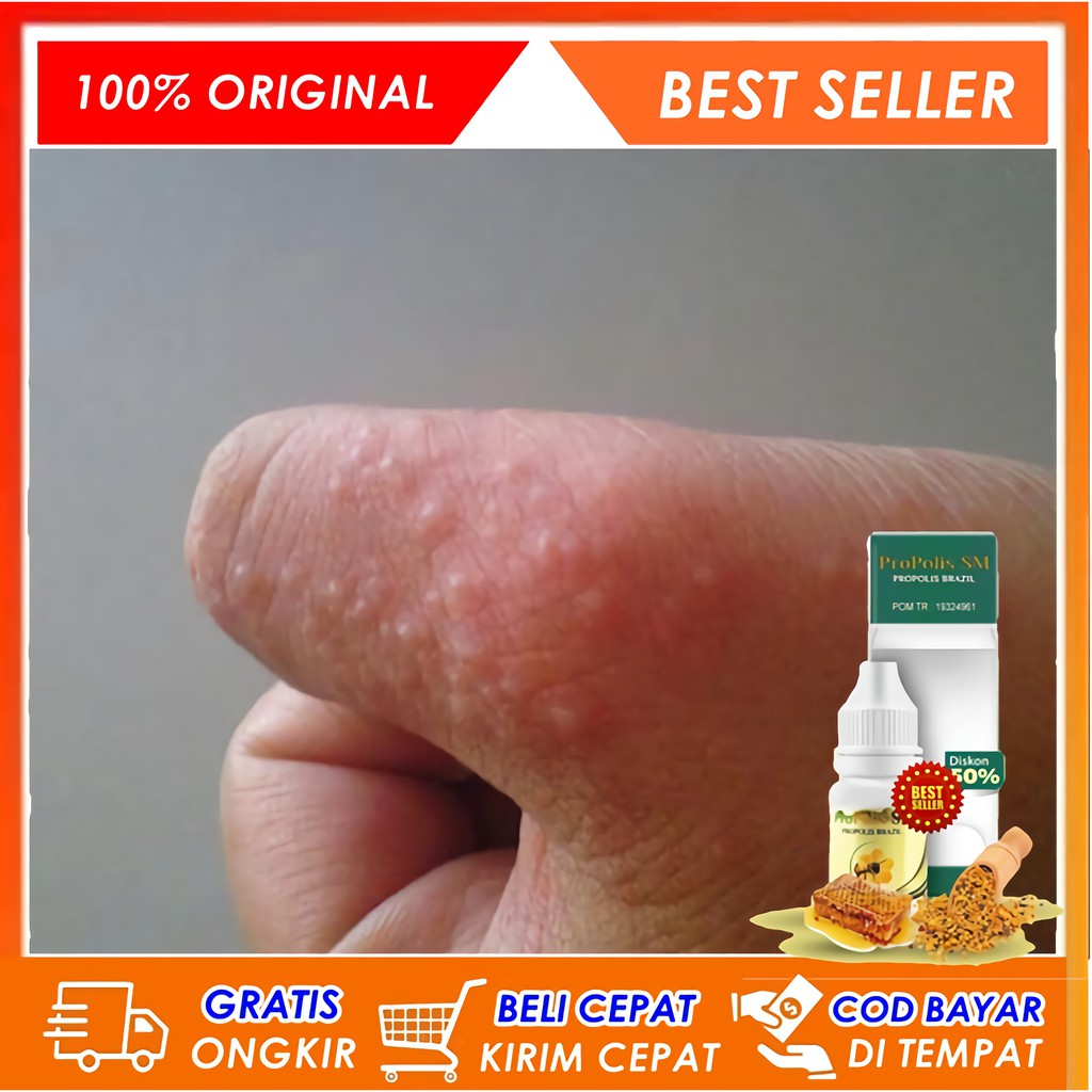 Jual Obat Gatal Berair Di Jari Tangan Dan Kaki Obat Bintik Bening Berair Gatal Bernanah 8441