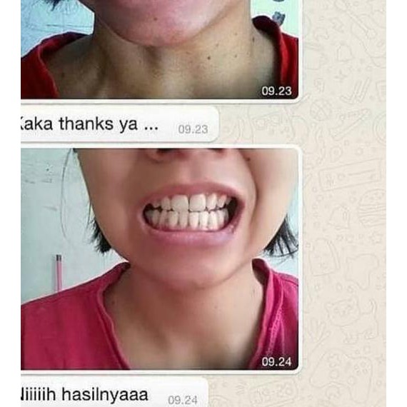 Terbaru [ BISA  ] Perapih GIGI Behel teeth trainer alignment (PREMIUM) Dijamin Asli 100% vai...