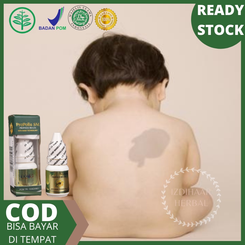 Obat penghilang tanda lahir, Penghilang tanda olahir coklat, Penghilang tanda lahir, Obat penghilang