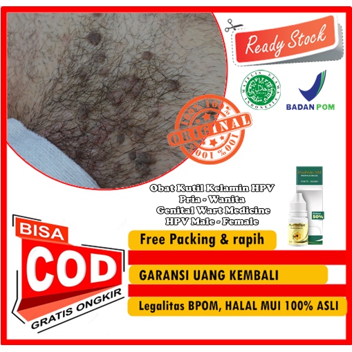 Obat Kutil Kelamin HPV Pria - Wanita / Genital Wart Medicine HPV Male - Female / Ubat Ketuat Kemalua