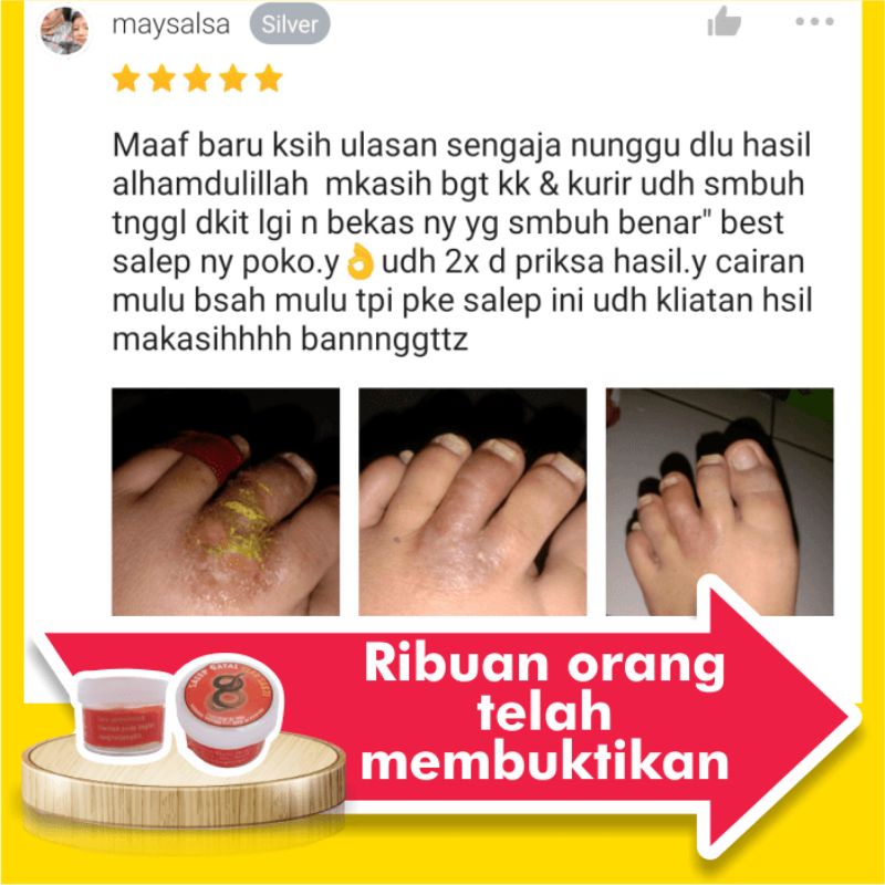 Obat Salep Gatal Eksim Kering Menahun Paling Ampuh Kulit Gatel Basah Selangkangan Kurap Kutu Air Luka Diabetes Panu Kudis Kadas-2