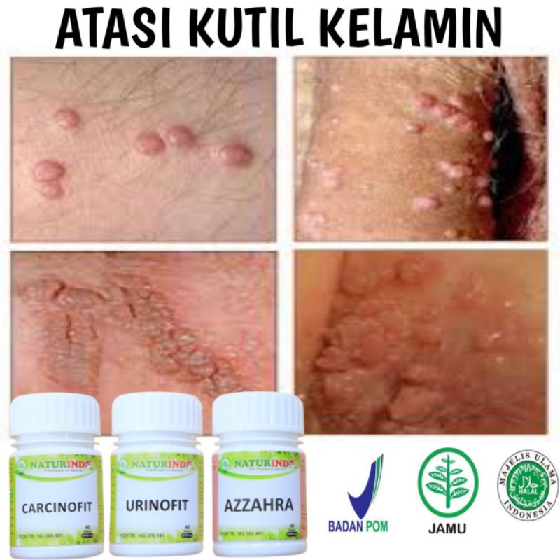 OBAT KUTIL KELAMIN AMPUH PERONTOK KUTIL KELAMIN PALING AMPUH