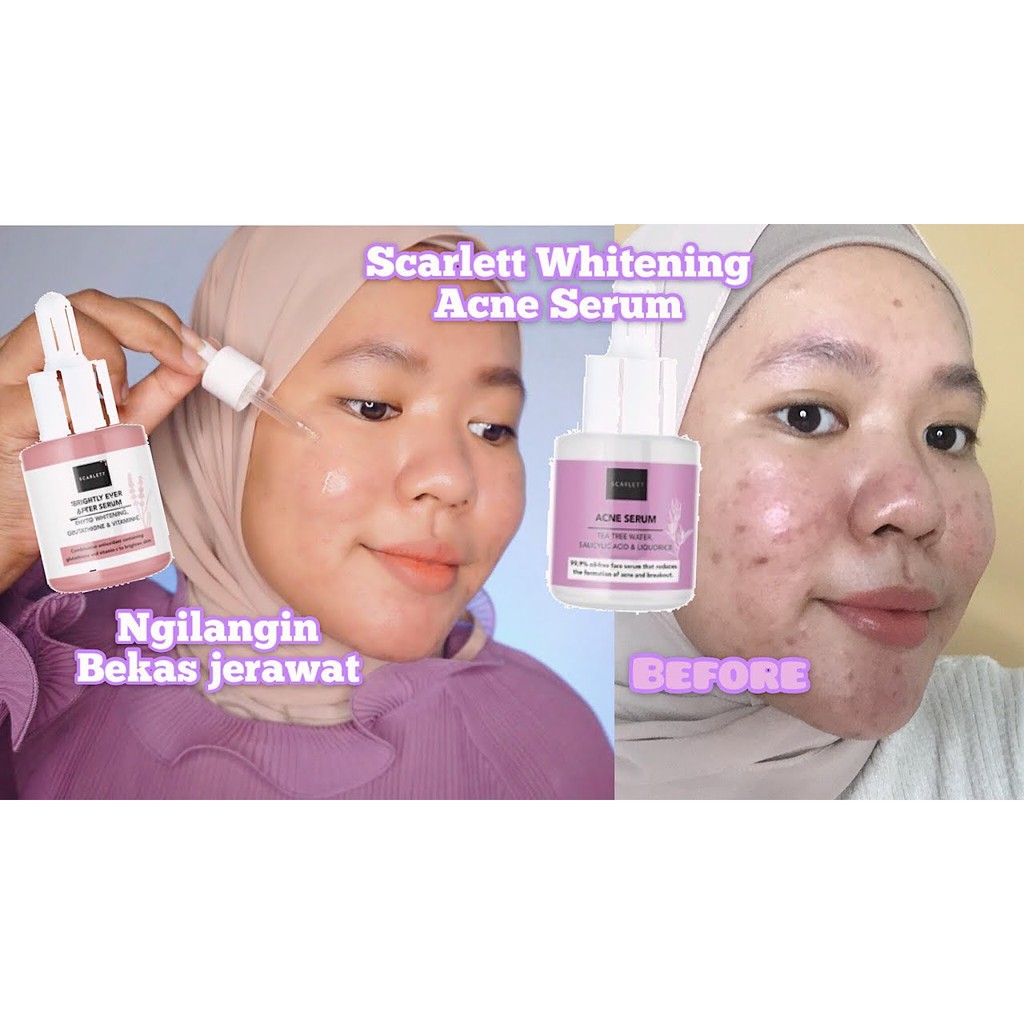 Scarlett  READYY Whitening Acne Serum