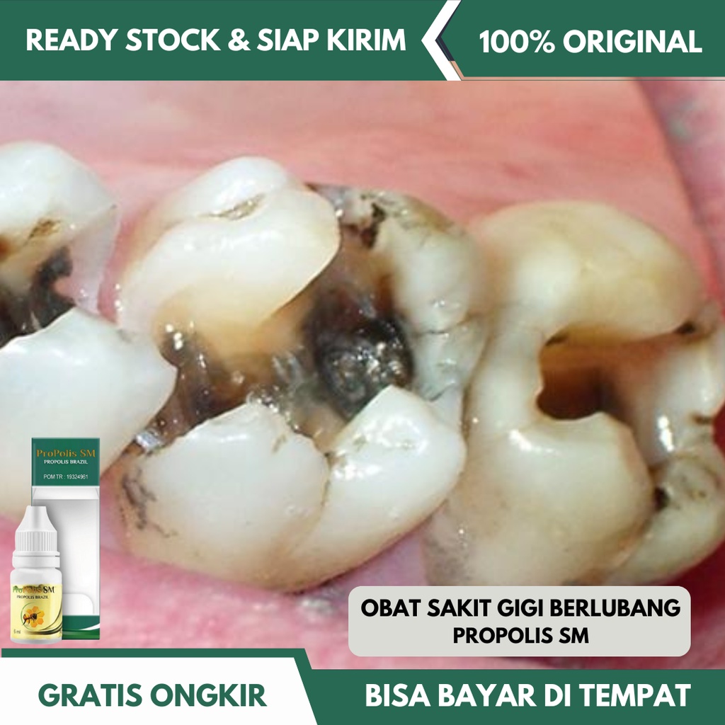 Obat Sakit Gigi Berlubang Alami Aman Tanpa Efek Samping - Obat Gusi Bengkak Gigi Sakit Dan Linu Nyer