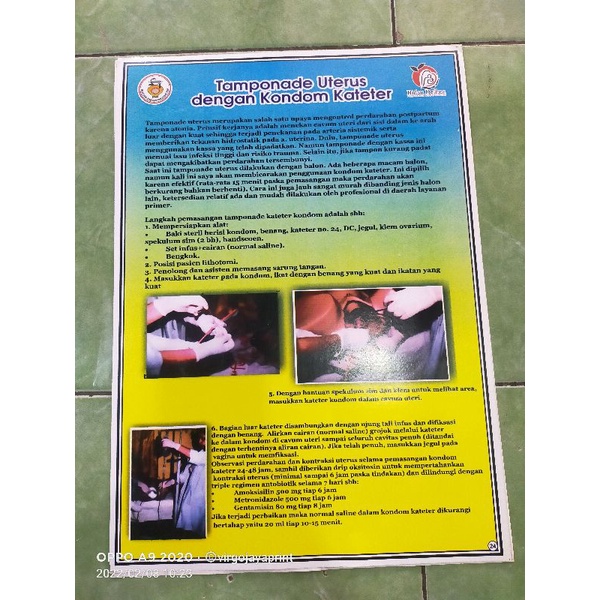 

(24) POSTER TAMPONADE UTERUS DGN KONDOM KATETER