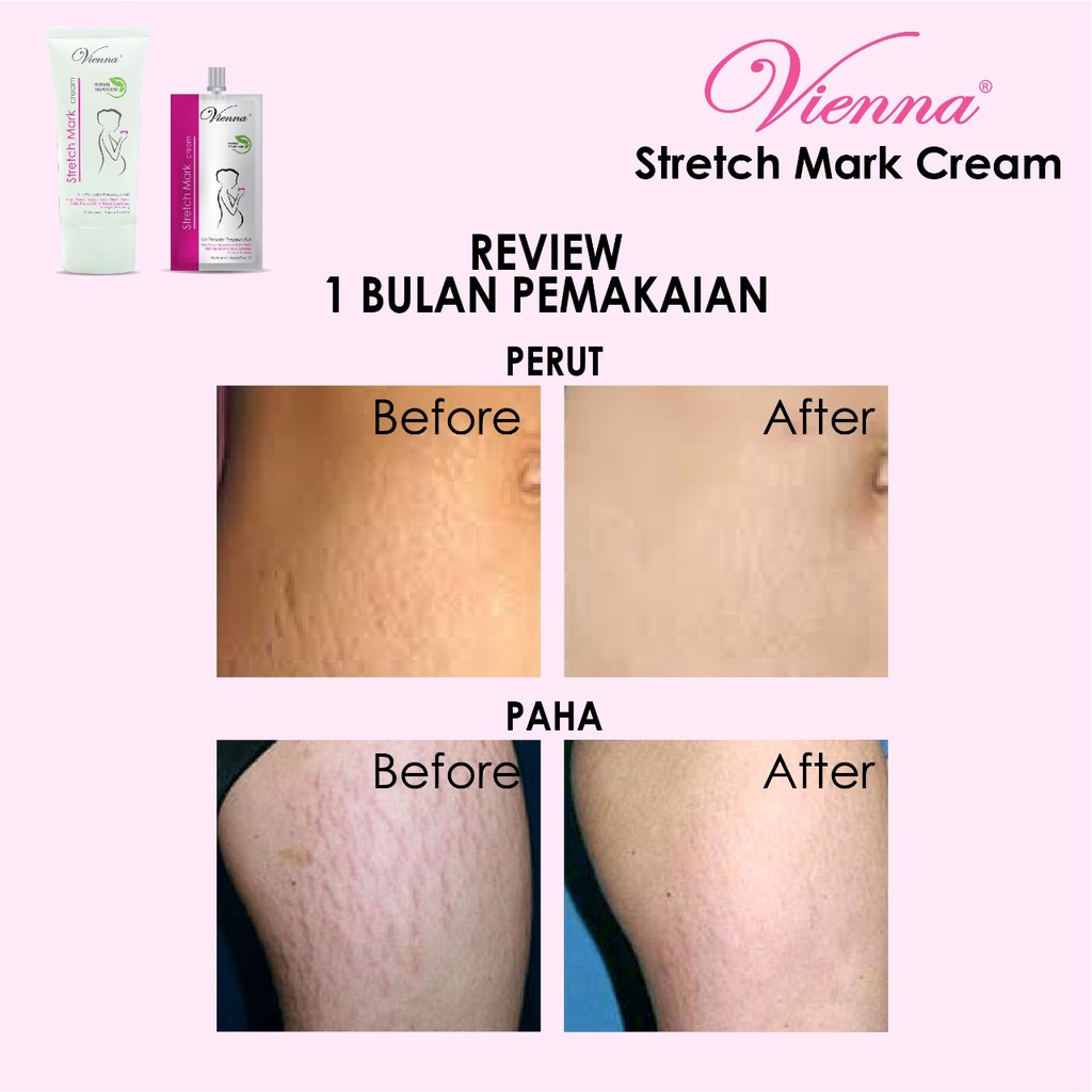 Vienna Strecth Mark Cream 80mL