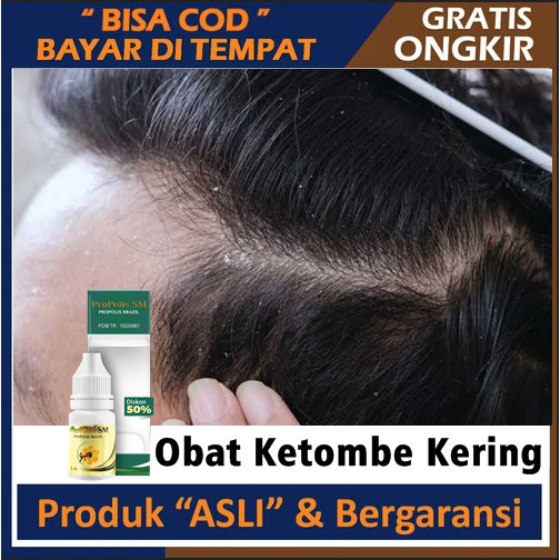 Obat Ketombe Kering - Obat Hilangkan Ketombe Membandel, Ketombe Berkerak, Ketombe Menahun
