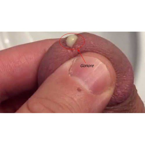 Gonore STD Facts