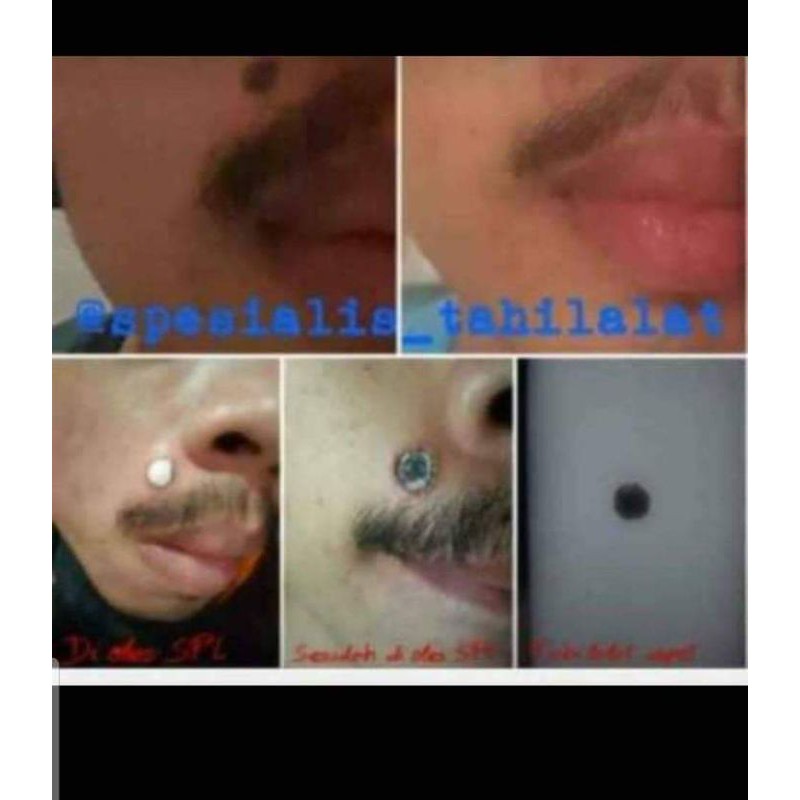 BINAHONG OBAT PENGHILANG TAI LALAT/KUTIL AMPUH(GARANSI KALAU GK AMPUH)