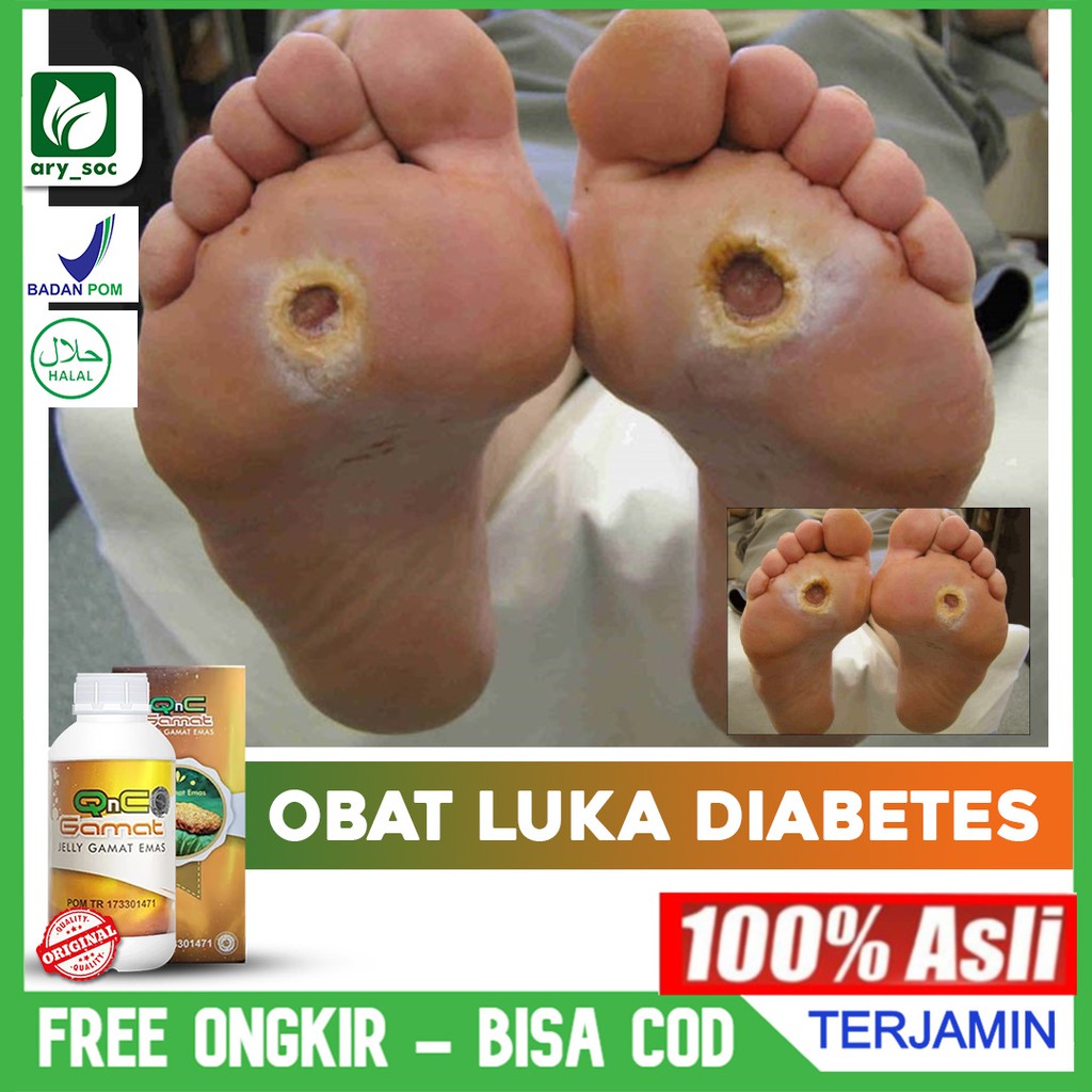 Obat luka diabetes basah tradisional