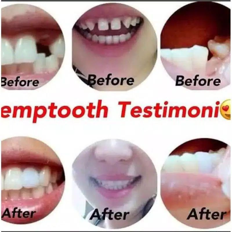 PENAMBAL GIGI *RENGGANG/PATAH/OMPONG/BOLONG*