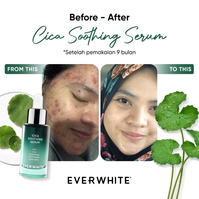 C Everwhite Cica Soothing Serum (Untuk Jerawat yang bandel)