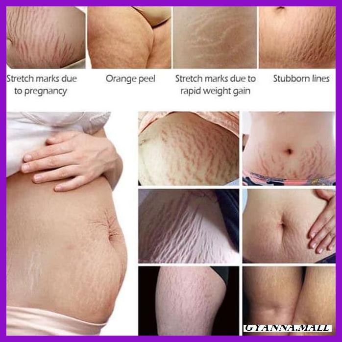 

KRAMHCTERTS-MAERC- VIBRANT GLAMOUR CAYMAN GEL MENGHILANGKAN BEKAS LUKA STRECTH MARK -NO-LINE.
