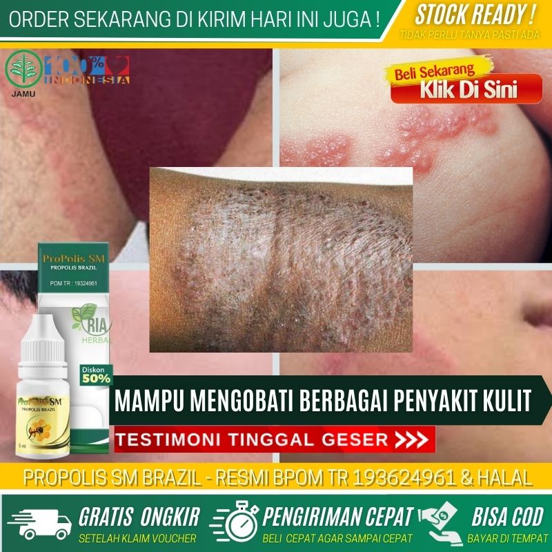 OBAT GATAL KULIT JAMUR DI WAJAH DAN LEHER, SALEP OLES PENGHILANG PANU, HAPURAN, KADAS, KURAP, EKSIM,