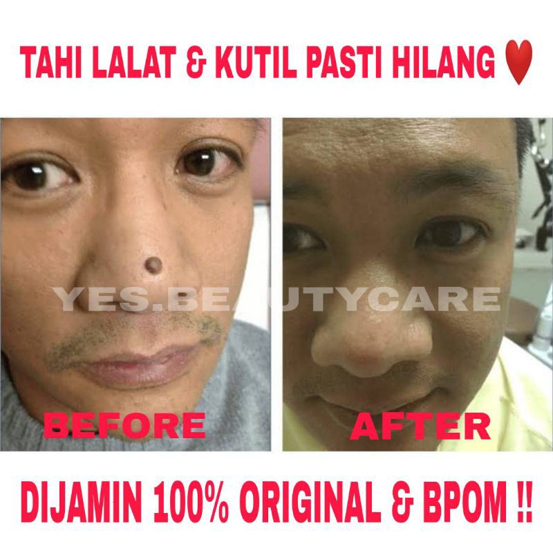 SWISS PARIS LOTION PENGHILANG TAHI LALAT &amp; KUTIL - SPESIALIS_TAILALAT - KRIM TAI LALAT OBAT ORIGINAL