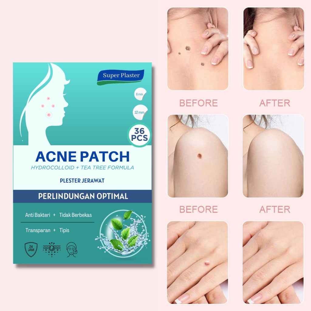 ( BUNDLE) Acne Patch Jerawat / Acne Treatment 108 Pcs - with Tea Tree and Hydrocolloid - Asam Salisilat