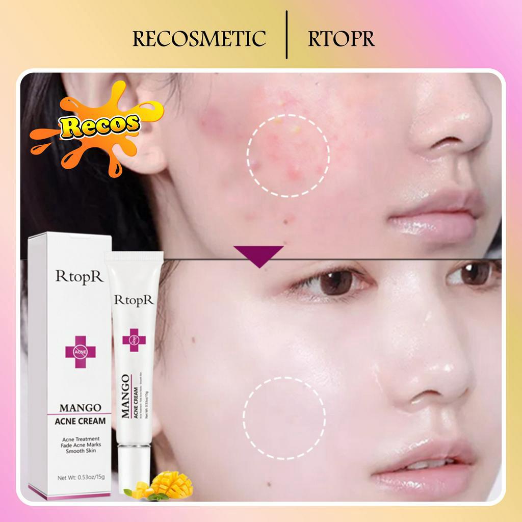 RtopR  MANGO Repair Acne Cream Cream Anti Acne Spots Acne Treatment Scar Blackhead