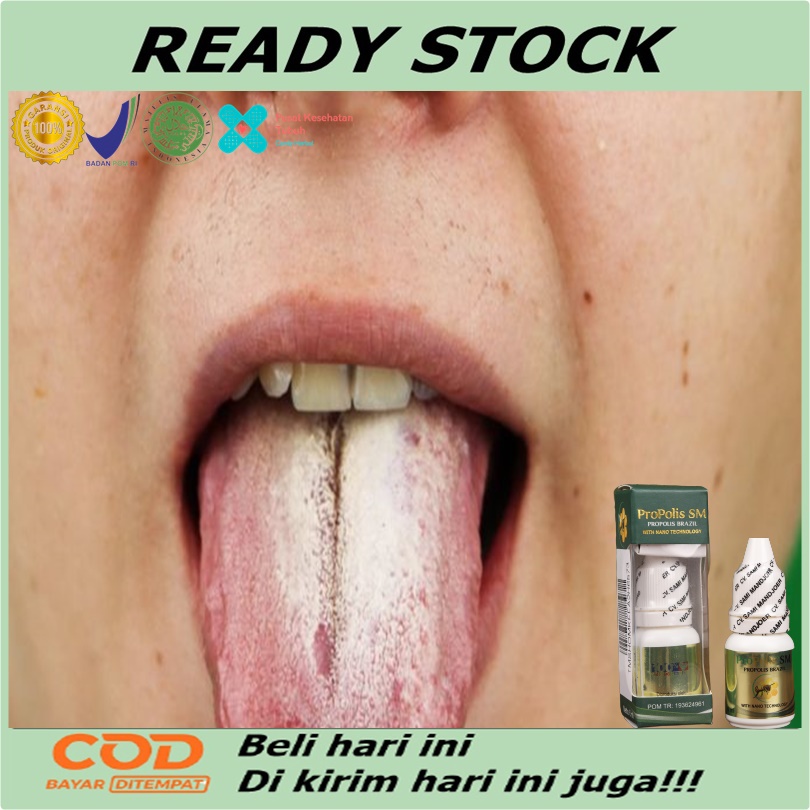 Obat jamur di lidah, Obat penghilang putih di lidah, Obat kandidiasis mukokutan, obat pembersih lida