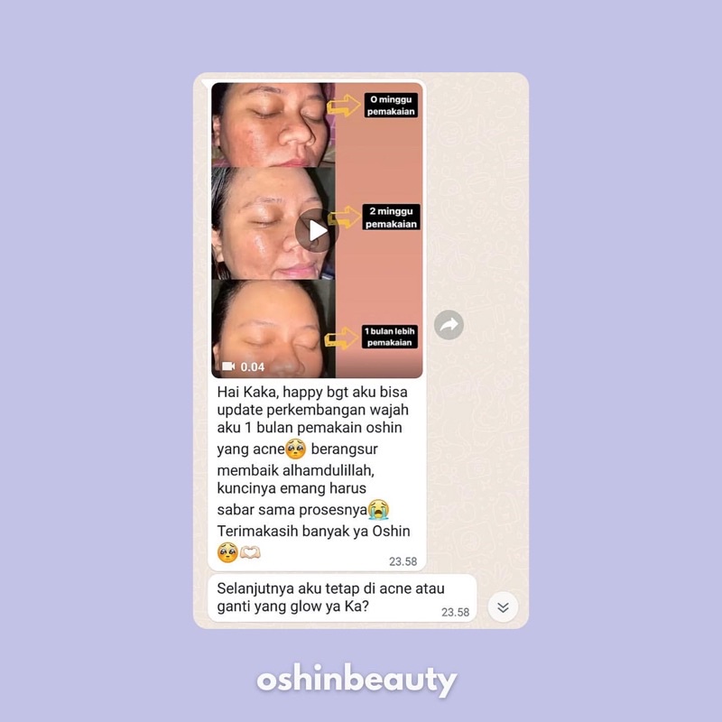 (ECER ACNE) OshinBeauty - Acne Series Oshin Beauty Skincare [Free Gift]-4