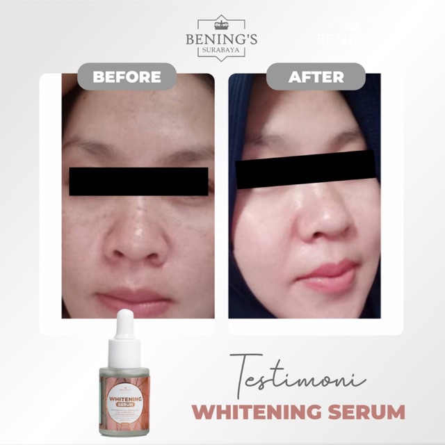 BENING'S WHITENING SERUM KULIT KUSAM DR OKY PRATAMA