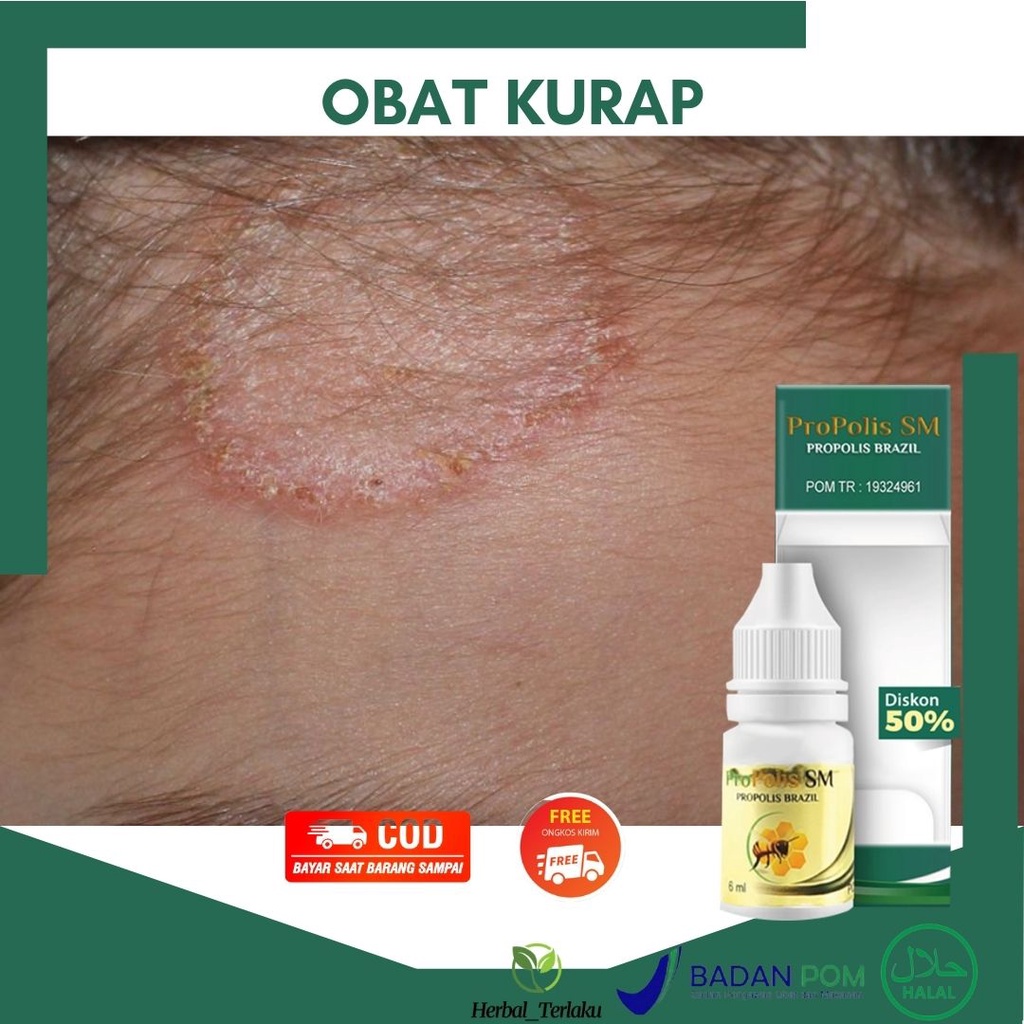 Jual Obat Oles Ruam Melingkar Di Kulit - Ruam Merah - Kulit Bersisik