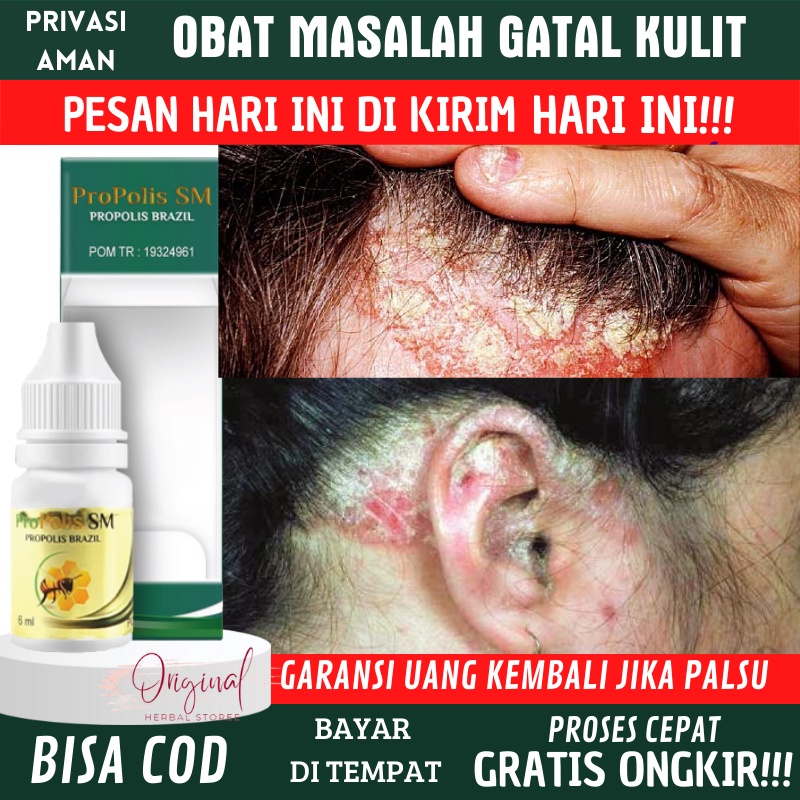 Obat jamur kulit kepala ketombean parah Ketombe bersisik bau dan gatal Obat kulit kepala, Obat ketom