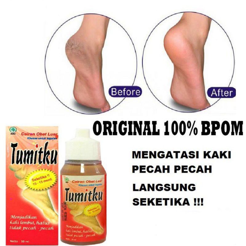 TUMITKU OBAT KAKI PECAH PECAH