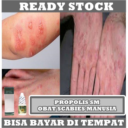 Obat Scabies Manusia, Borok Budug Cenang Bernanah, Cenang Di Kaki, Cenang Di Telapak Kaki, Obat Gatal Bernanah, Kulit Nanahan, Cenang Berair, Salep Penghilang Cenangan, Benjolan Nanah Di Jari Jari Kaki, Luka Borok Bernanah - Propolis SM