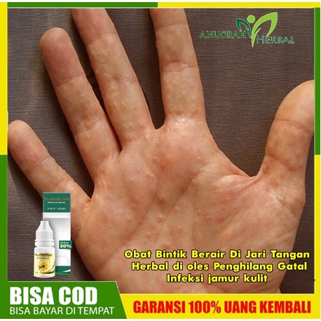 Obat Bintik Berair Di Jari Tangan - Herbal di oles Penghilang Gatal Infeksi jamur kulit, Dermatitis 