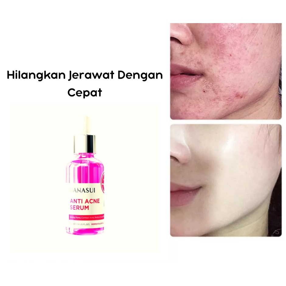 [ORI] Hanasui Serum Pink Anti Acne Melembabkan Kulit Kering Mencegah dan Mengurangi Jerawat pada Wajah | BPOM 20ml