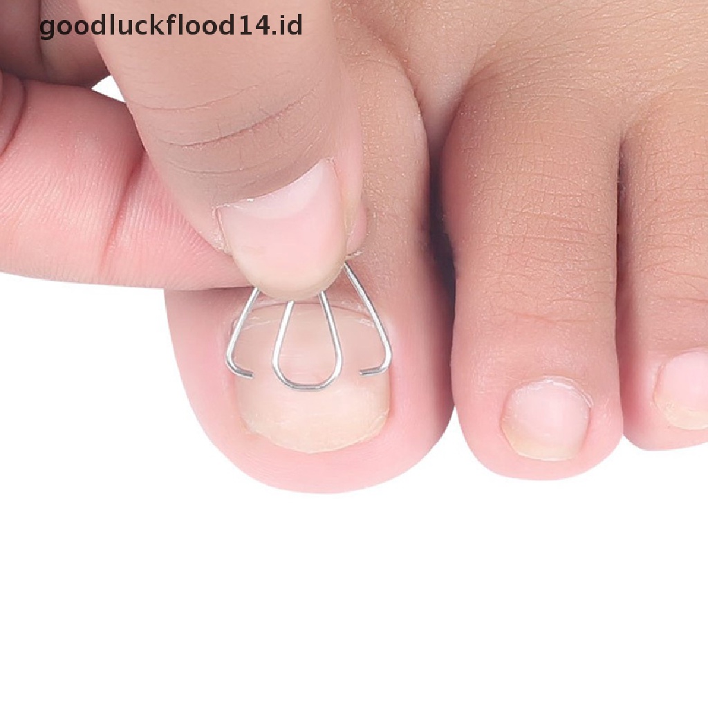 [OOID] Nail Art Ingrown Toe Nail Correction Tool Toenail Nail Orthosis Paronychia Clip ID