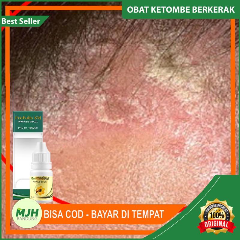 Obat Ketombe Membandel Parah - Ketombe Berkerak Kering