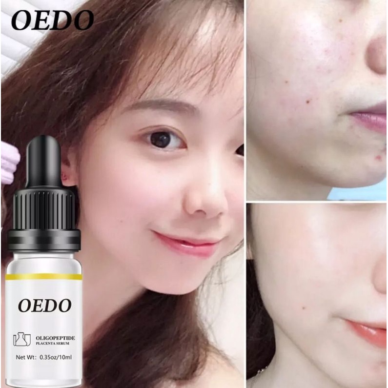 OEDO OLIGOPEPTIDE PLACENTA SERUM FACE CREAM ACNE TREATMENT SKIN CARE REPAIR WHITENING ANTI AGING WINKLES ESSENCE