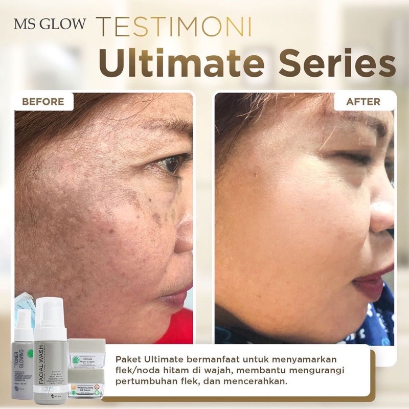 MS GLOW [𝐁𝐏𝐎𝐌] PAKET WHITENING ACNE ULTIMATE LUMINOUS ORIGINAL 100% Paket Wajah Lengkap Semua Series Msglow