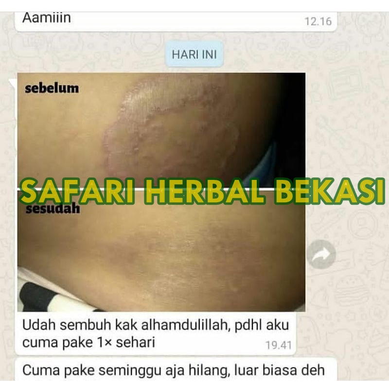 Obat Untuk Memutihkan Selangkangan Yang Hitam, Pemutih Selangkangan Hitam, Gatel Selangkangan, Obat Gatal Selangkangan - Propolis SM 100% Original-1