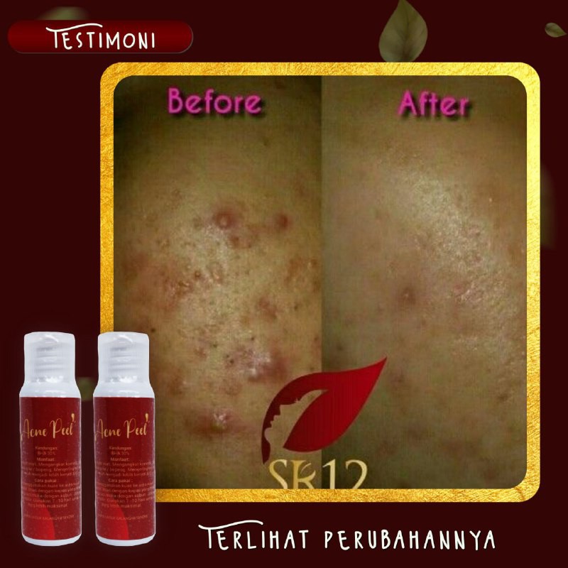 ACNE PEEL SR12 / PEELING WAJAH