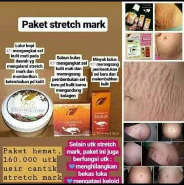 SR12 PAKET PENGHILANG STRETCHMARK / MENGENCANGKAN KULIT / MENCERAHKAN KULIT / MENGHILANGKAN BEKAS LUKA ATAU GATAL