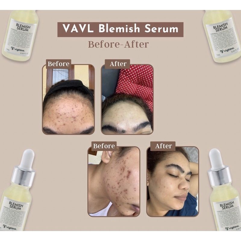 VIGHTNE BLEMISH SERUM by VAVL BEAUTE