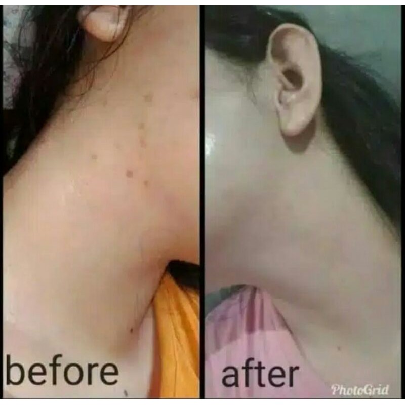 Sabun Acne Deswari