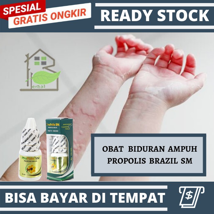 Obat Biduran Ori Alergi Dingin Kaligata Gatal Gatal Eksim Ruam Bintik Merah Propolis Sm Gold Shopee Indonesia